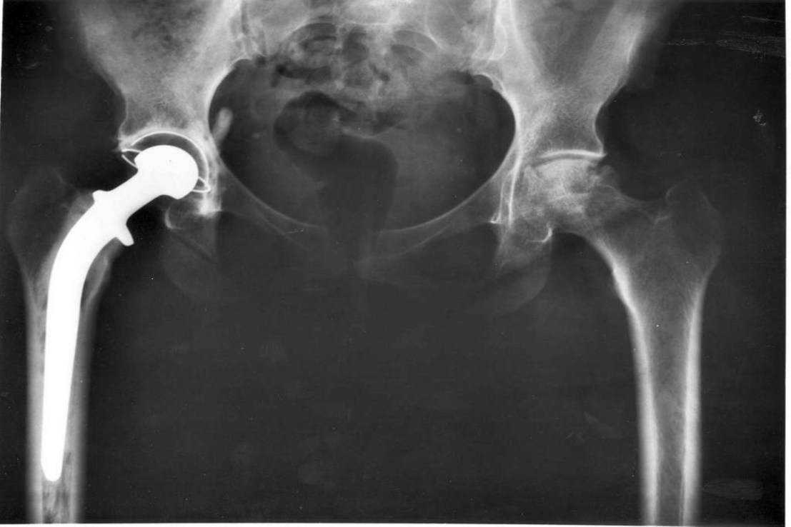 Smith & Newphew is one of the world's largest hip replacement manufacturers